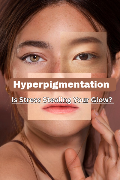 Hyperpigmentation: Is Stress Stealing Your Glow – Skin Darkening: Causes and Prevention